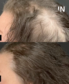 CALECIM® Advanced Hair System