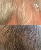 CALECIM® Advanced Hair System