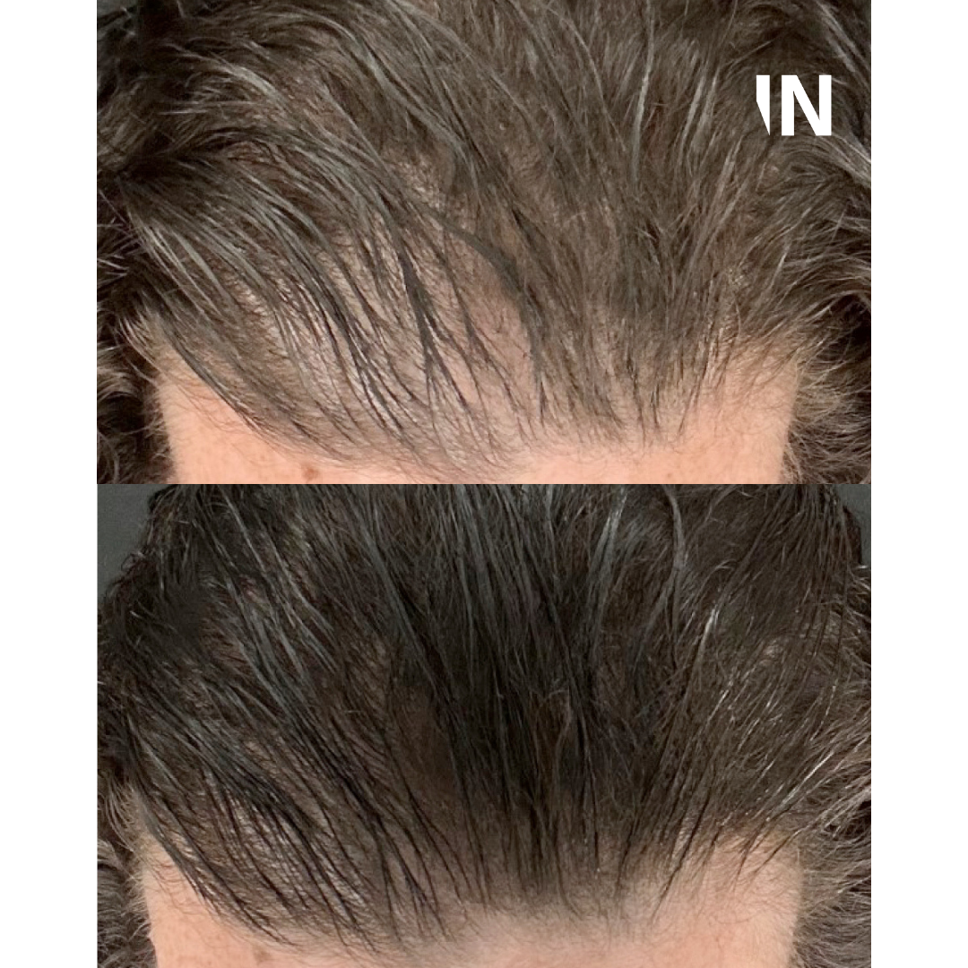 CALECIM® Advanced Hair System