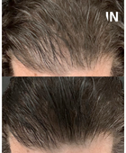 CALECIM® Advanced Hair System